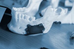 Bei der Bearbeitung von medizinischen Bauteilen aus Titan wird häufig eine leistungsstarke Absaugung benötigt.